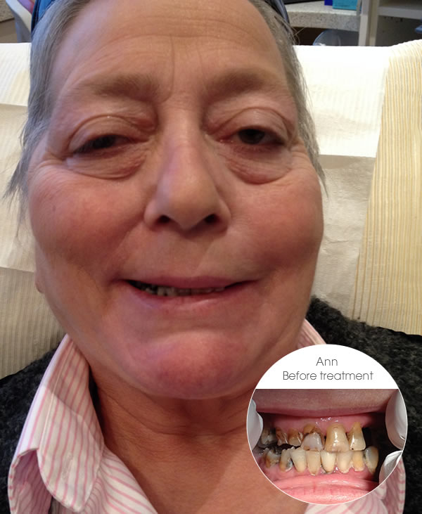 smile makeover ann before treatment at brunswick dental